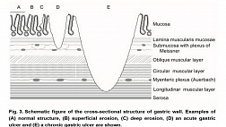 Классификация эрозий желудка по Тольямо (Toljamo), 2012